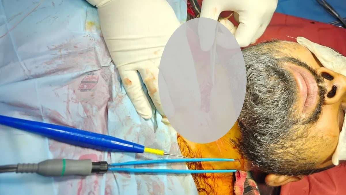 वाराणसी में चाइनीज मंझे का खौफ, बिजली विभाग के सुपरवाइजर की गर्दन कटी