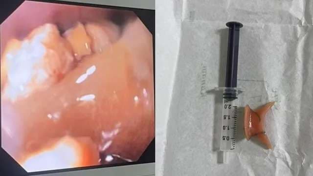 आंत में फंसे नकली दांत को बीएचयू के डाक्‍टरों ने मशक्‍कत के बाद निकाला, मरीज की जान बची...