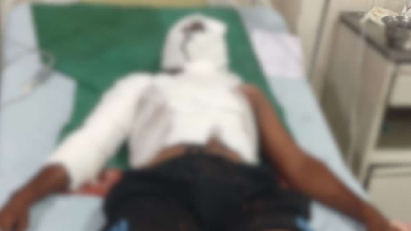 वाराणसी में घर के बरामदे में सो रहे छात्र पर एसिड अटैक, पुलिस तहकीकात में जुटी...